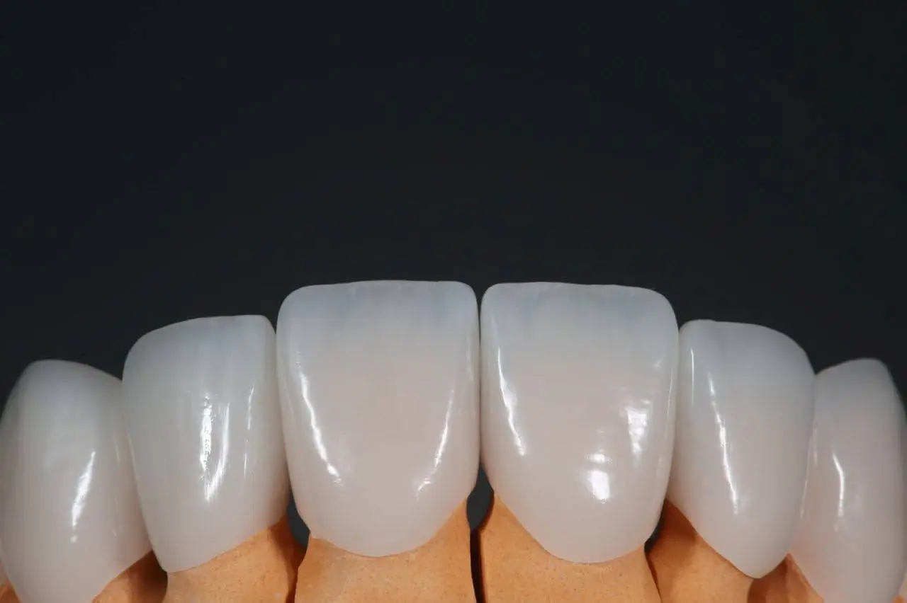 Тотальные конструкции на своих зубах. От макета к финальным реставрациям