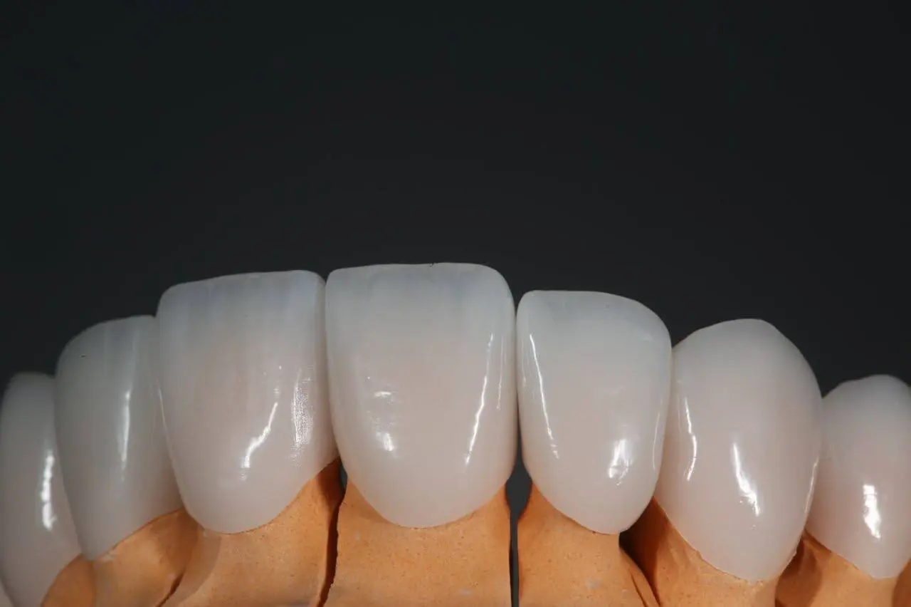 Тотальные конструкции на своих зубах. От макета к финальным реставрациям