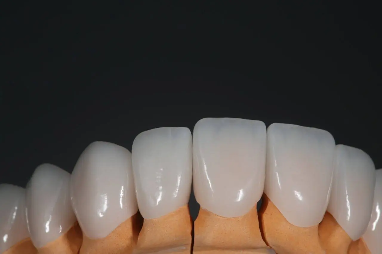 Тотальные конструкции на своих зубах. От макета к финальным реставрациям