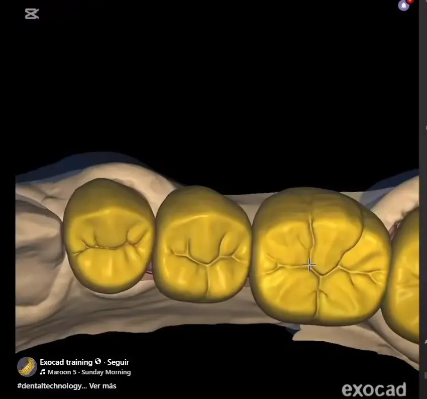 Exocad training 6 Seguir ' Maroon 5 Sunday Moming #dentaltechnology