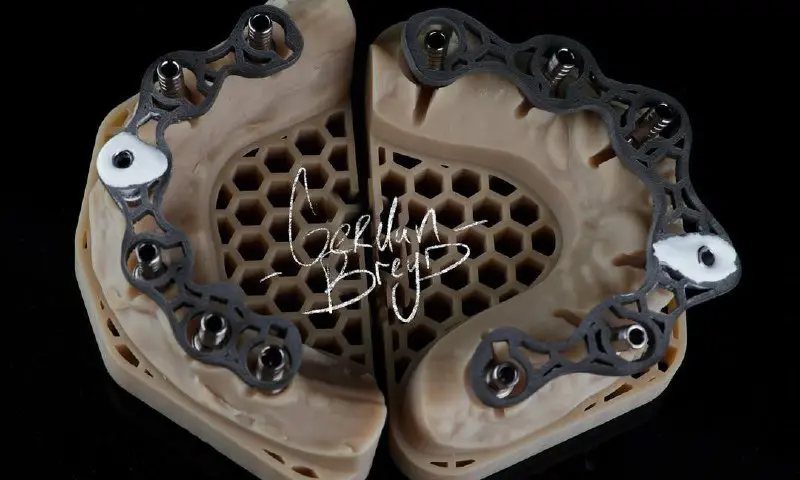 Цельноциркониевые коронки с уровня имплантата. Винтовая фиксация